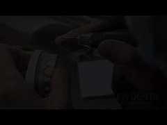 Les facettes de sauterelle sont la solution parfaite pour les facettes dentaires translucides naturelles