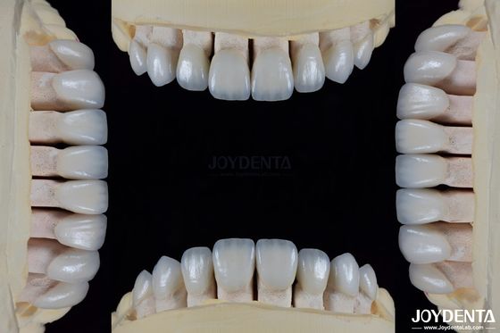 Céramique pour l'esthétique naturelle Faisceaux dentaires Résistance aux taches Maintient la luminosité Une forte liaison avec l'émail des dents pour un ajustement sûr