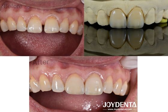 0.5mm épaisseur faisceaux dentaires Perméabilité parfaite Faisceaux de porcelaine pour les dents creuses