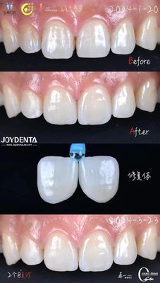 Indication des dents antérieures Faisceaux dentaires sans préparation et sans décoloration