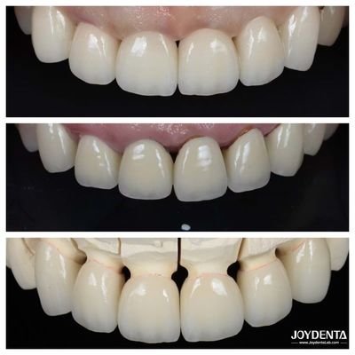 Excellente biocompatibilité Les facettes de porcelaine dentaire n'ont pas besoin d'être préparées