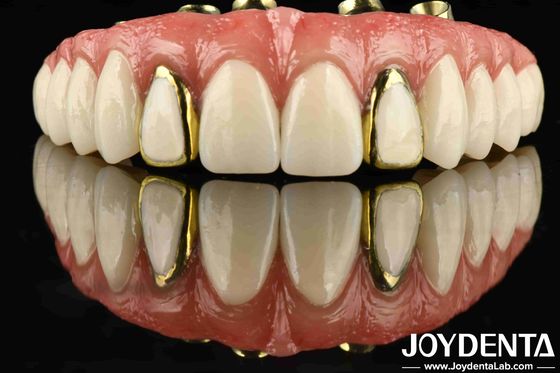 Découvrez la durabilité du pont hybride de titane Malong pour la dentisterie appliquée