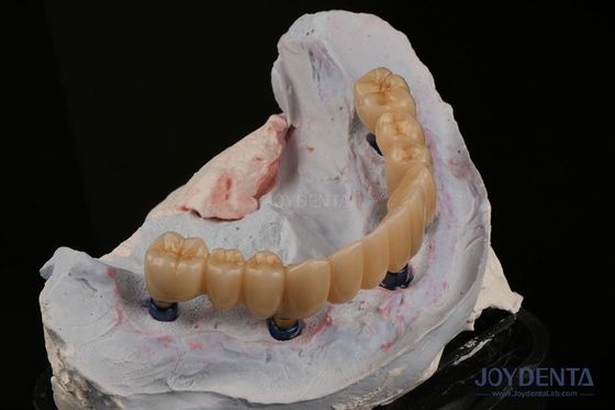 acheter Restauration dentaire Implantation de dents multiples Endosseuse Remplacement de deux dents avant fabrication en ligne