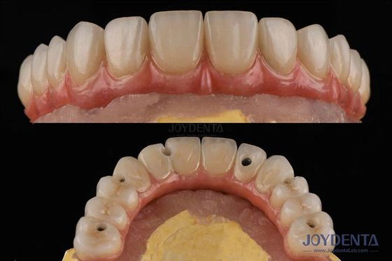 acheter Plateforme d'implantation dentaire de surface rugueuse Ponts dentaires avec connexion interne fabrication en ligne