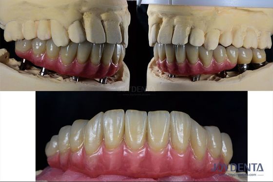 acheter Reconstruction dentaire Implant de dents multiples Titane Prothèse de connexion interne fabrication en ligne