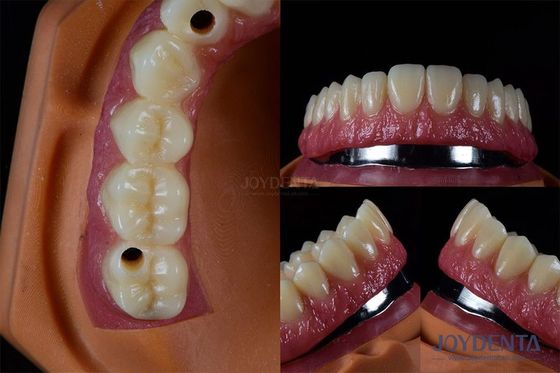 acheter Implants dentaires multiples en titane Dents Implants internes résistants aux fissures personnalisés fabrication en ligne