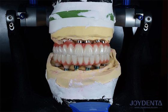 acheter Implantation de dent unique de 10 mm de long pour obtenir des résultats chirurgicaux optimaux. fabrication en ligne