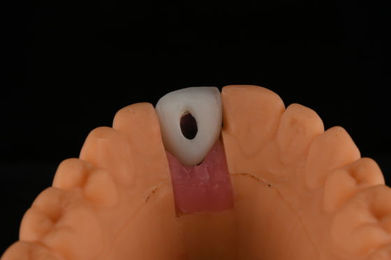 acheter Implants dentaires en titane à surface rugueuse Chirurgie pour le remplacement des dents avant fabrication en ligne