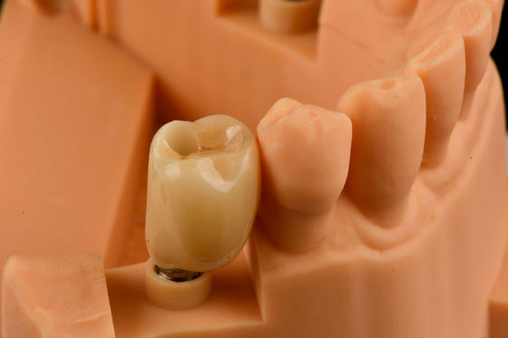 acheter Connexion hexagonale interne Implants dentaires en titane sablés Remplacement d'une seule dent fabrication en ligne
