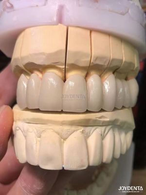 acheter Porcelaine de précision fusionnée au métal couronnes PFM sans couture Amélioration du sourire naturel fabrication en ligne