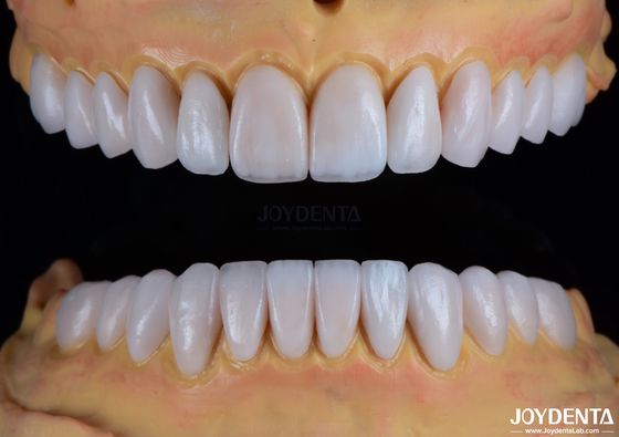 acheter Maintenance de la résistance aux taches et de la luminosité Les facettes dentaires pour les dents éclaboussées garantissent la transformation fabrication en ligne
