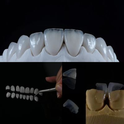 acheter Veneur en verre céramique: un sourire naturel grâce à cette solution dentaire de qualité supérieure fabrication en ligne