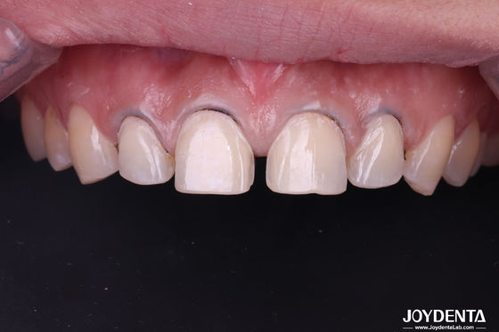 acheter Veneurs de porcelaine dentaire à l' allure réelle, parfaitement adaptés aux dents, veneurs en céramique pour les dents de devant fabrication en ligne