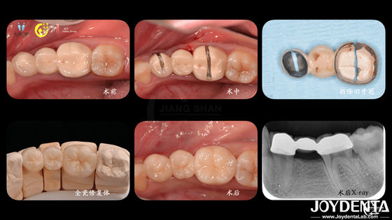 acheter Couronne dentaire en zirconium sur mesure Biocompatibilité Confort Personnalisation pour une expérience optimale du patient fabrication en ligne