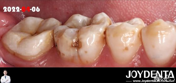 acheter Couleur naturelle, incrustation dentaire adaptée pour la restauration des dents endommagées fabrication en ligne