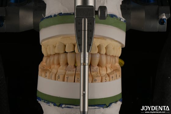 acheter Haut esthétique Zirconia dentaire en porcelaine en couches pour la restauration des implants fabrication en ligne