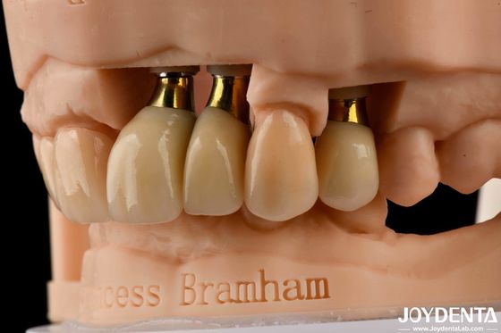 acheter Implants dentaires de précision couronne et pont Solution parfaite pour un sourire esthétique fabrication en ligne