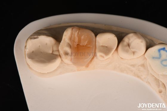 acheter Inlay en zirconium Onlay avec ciment adhésif pour la restauration des dents endommagées fabrication en ligne