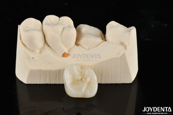 acheter Des incrustations et des onlays en zirconium réalisés sur mesure pour un ajustement et une esthétique inégalés fabrication en ligne