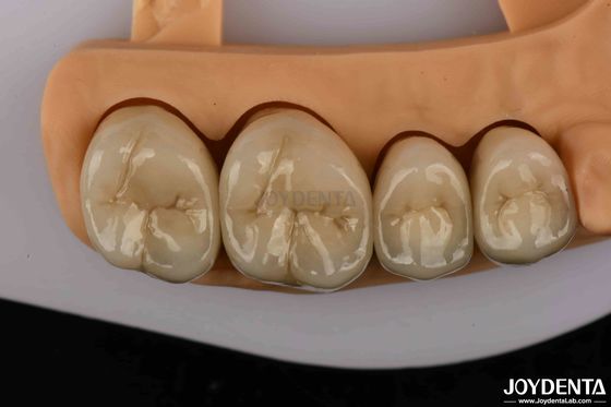 acheter Des couronnes dentaires en alliage d'or et de palladium de qualité supérieure pour une plus grande durabilité fabrication en ligne