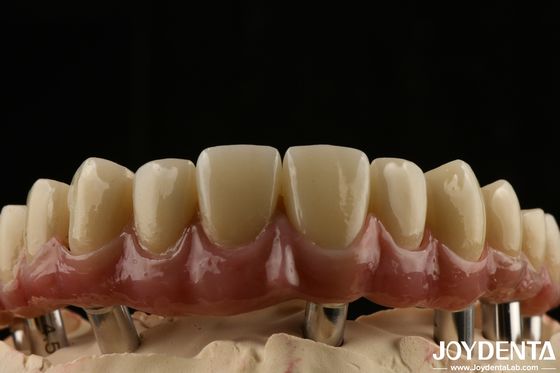 acheter Titane Malong pont dentaire hybride durable ajusté à la forme basse densité fabrication en ligne