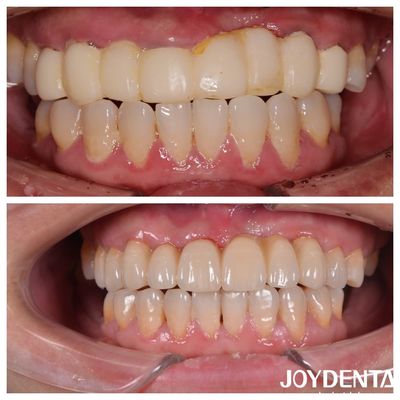 acheter Des ponts dentaires en zirconium multicouches de couleur naturelle pour une expérience optimale du patient fabrication en ligne