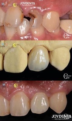 acheter Appareil des dents réalistes Zirconia ponts Restauration dentaire Résistant à l'usure Personnalisé fabrication en ligne