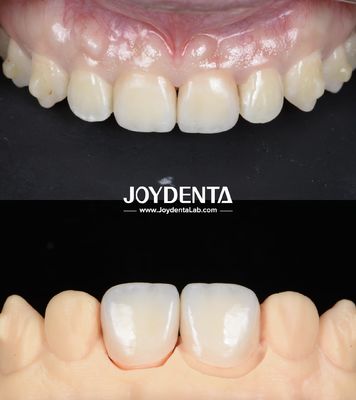acheter Des ponts dentaires en zirconium à surface lisse et légère pour les restaurations à l'aide d'implants fabrication en ligne