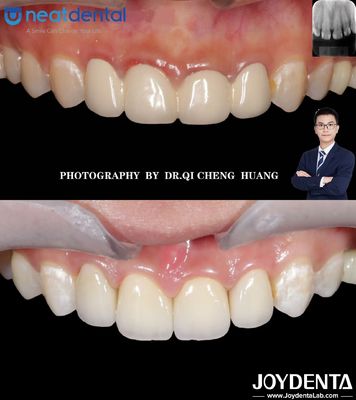acheter Couronne en zirconium à haute translucide multicouche pour dents antérieures et postérieures résistantes aux fissures fabrication en ligne