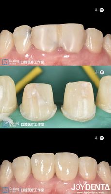 acheter Dents parfaitement ajustés couronnes dentaires en zirconium avec systèmes CAD CAM pour la fabrication de précision fabrication en ligne