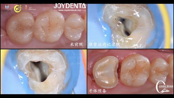 acheter Longue durée d'apparence naturelle incrustation en céramique dentaire ajustement précis Compatibilité élevée fabrication en ligne