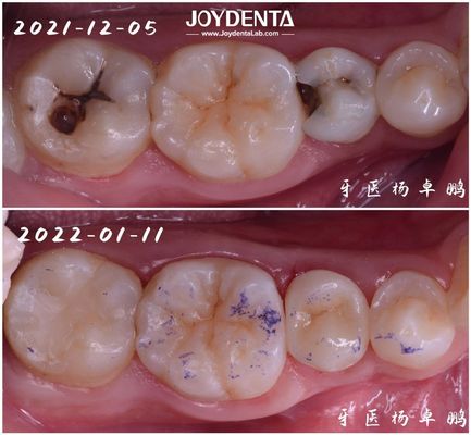 acheter Restoration dentaire par incrustation de haute durabilité pour les dents endommagées fabrication en ligne