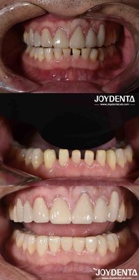 acheter Forme naturelle Porcelaine cosmétique Dentisterie Porcelaine dentistique Porcelaine cosmétique fabrication en ligne