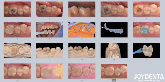 acheter Adultes Enfants Porcelaine en céramique en incrustation dentaire pour les dents endommagées fabrication en ligne