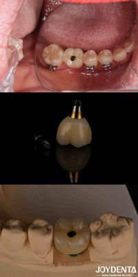 acheter 4-6 Implantation dentaire endosseuse conique, niveau osseux sous-cristale et connexion hexagonale interne fabrication en ligne
