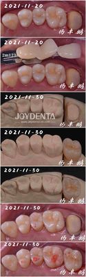 acheter Procédure dentaire en porcelaine en incrustation sans couture Forme personnalisable pour la réparation des dents fabrication en ligne