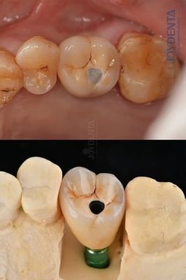 acheter Implants dentaires en titane à pleine voûte Plateforme prothétique 4,1 mm Pour une durabilité exceptionnelle fabrication en ligne