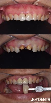 acheter Préparation biologiquement orientée Technique de préparation verticale dentaire Minimalement invasive fabrication en ligne