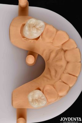 acheter Une esthétique naturelle avec une combinaison gagnante de zirconium dentaire biocompatible fabrication en ligne