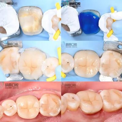 acheter Découvrez la précision de l'incrustation dentaire à prix abordable et blanche pour un ajustement parfait fabrication en ligne
