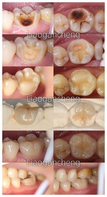 acheter Porcelaine Dental Inlay Restaurative Pour Adultes Et Enfants Performance exceptionnelle fabrication en ligne
