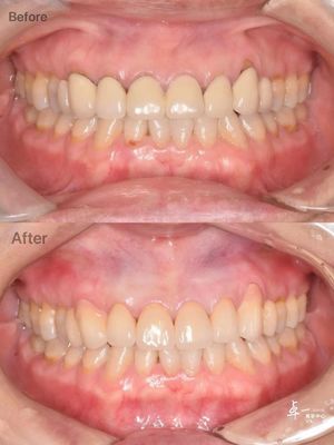 acheter Circonia dentaire résistante aux fractures pour des tissus oraux sûrs et une compatibilité CAO / CAM fabrication en ligne