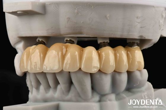 acheter Amis Proches de la Fondation Bones pour la Beauté des Implants en Zircone : Un Choix Esthétique Suprême Sans Risque d'Allergie aux Métaux fabrication en ligne