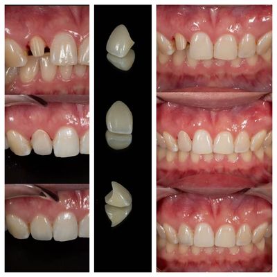 acheter Laboratoire de fabrication de couronnes dentaires en zircone | Externalisation de couronnes de précision - Joydentalab fabrication en ligne