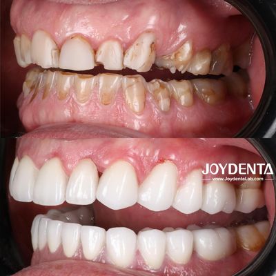 acheter Prothèses en zirconium qui imitent les dents naturelles fabrication en ligne