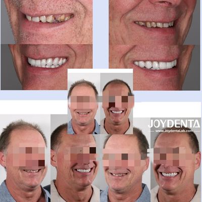 acheter Prothèses en zirconium qui imitent les dents naturelles fabrication en ligne