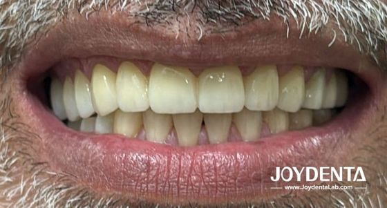 acheter Prothèses en zirconium qui imitent les dents naturelles fabrication en ligne