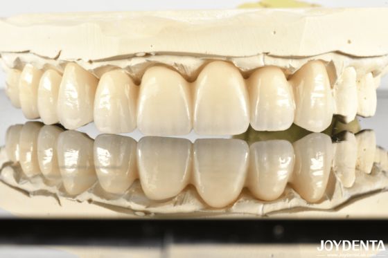 acheter Revolutionize Aesthetics & Strength: Introducing Our Multi-Layered Chromatic Zirconia Bridge fabrication en ligne