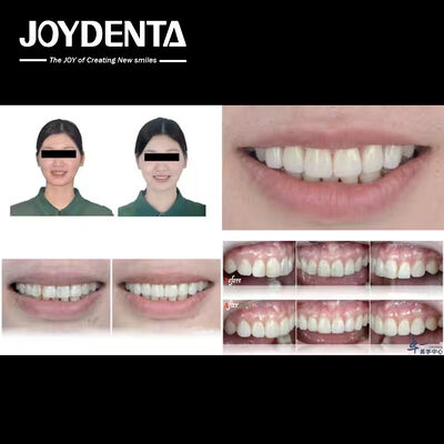 acheter Les produits populaires de Joydentalab: les placages esthétiques simulés fabrication en ligne
