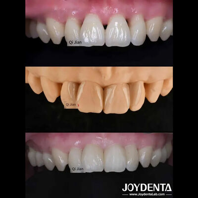 acheter Les facettes de sauterelle sont la solution parfaite pour les facettes dentaires translucides naturelles fabrication en ligne